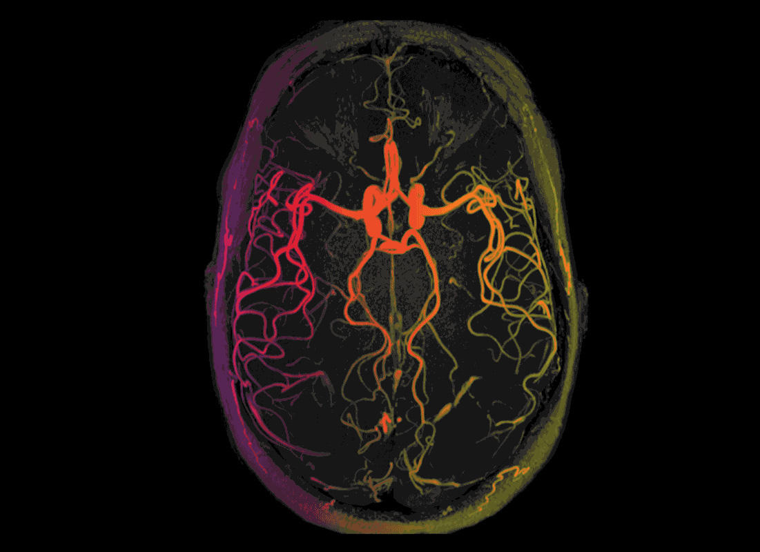 Brain scan