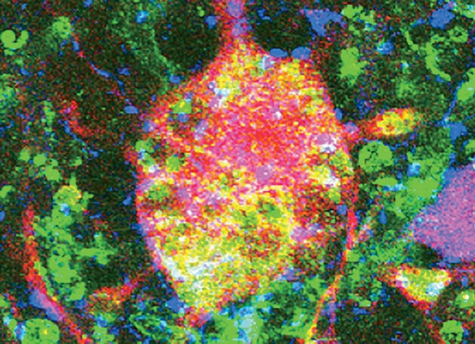 Neurons damaged by ALS