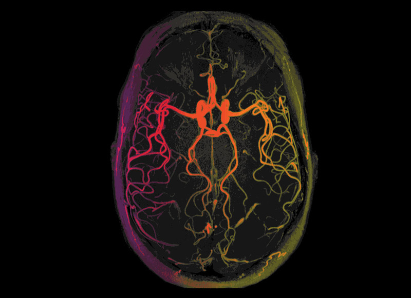 Brain scan