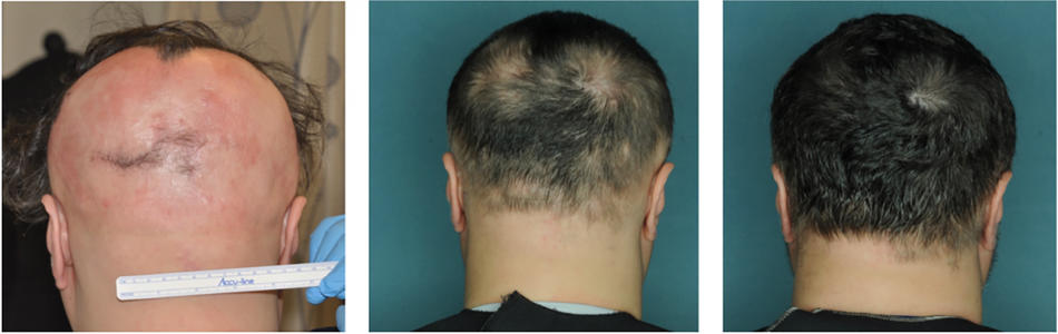 Photos of an alopecia areata patient who was treated with a JAK inhibitor and experienced near-total hair regrowth.